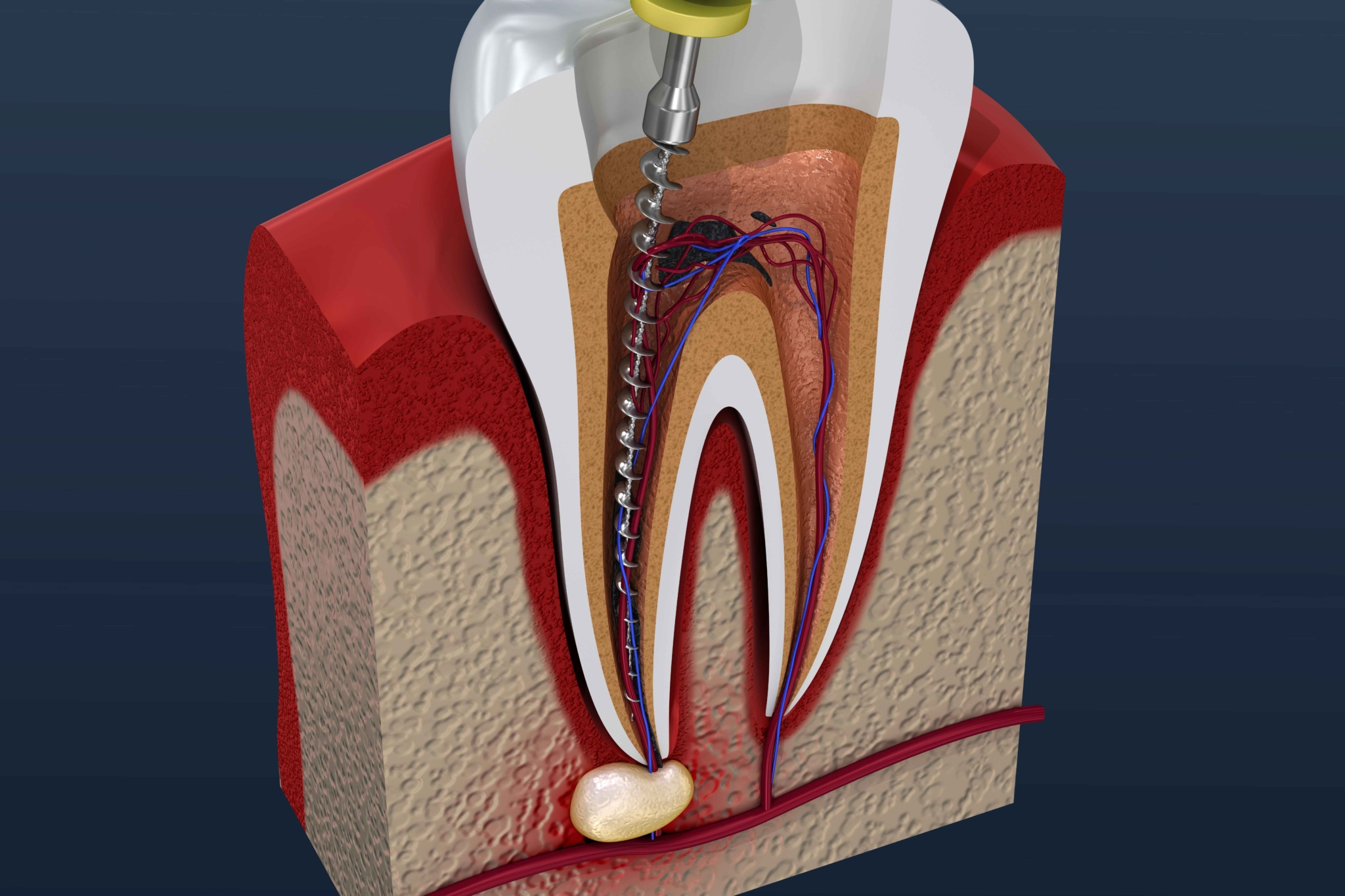 Multiple Root Tips Teeth How Many Times Can I Get a Root Canal on the Same Tooth?
